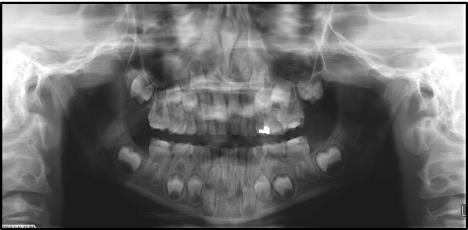 Figure 17: Panoramic radiograph showing molar- incisor- hypomineralization (MIH) with no discernable radiodensity of enamel only on first permanent molars and permanent incisors’ occlusal and incisal aspect respectively.