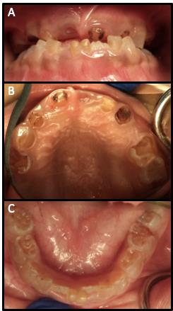Figure 18: Clinical photographs: Anterior bite (A), maxillary (B) and mandibular occlusal (C) demonstrating translucent appearance of all primary and permanent teeth in a six-year old patient due to Dentinogenesis Imperfecta (DI).