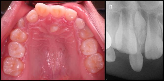 Figure 6: Clinical photograph of a mesiodens in an 11- year-old patient on the mid-palatal area (A), periapical radiographs of another 7-year-old patient showing two mesiodens (one erupted and one unerupted) between permanent central incisors.