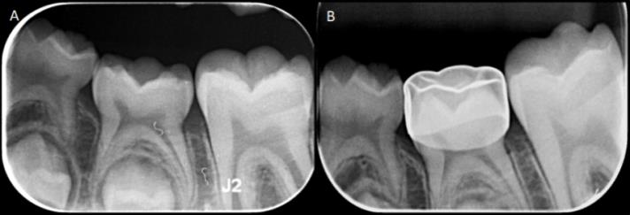 Figure 7: Periapical radiographs showing ankylosis of mandibular left second primary molar (submerged) with mesial tipping of permanent mandibular molar and distal tipping of first primary molar (A), restoration with stainless-steel crown to prevent reduction in arch length (B).