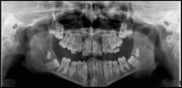Figure 8: Primary failure of eruption of mandibular second molars in a 16- year-old patient.