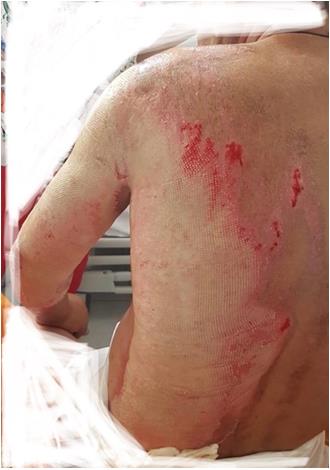 Figure 1: Seven days after burn injury, applying a “wait and see” approach.