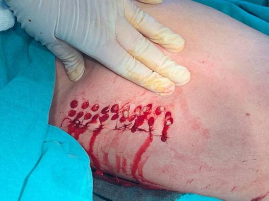 Figure 2: Tissue samples before the disaggregation; the skin sample contains both dermis and adipose tissue, known to be source of mesenchymal stem cells.