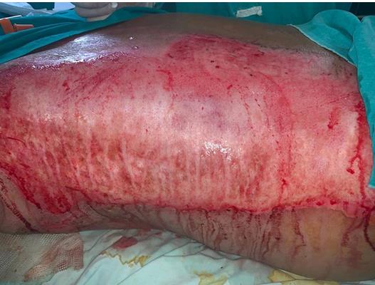 Figure 4: Immediately postoperatively.
