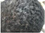 Figure 1: Trichophytic tinea due to T. tonsurans.