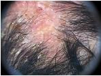 Figure 5: Kerion Celsi, zig zag hairs.