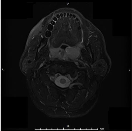 Figure 1: Axial section MRI.