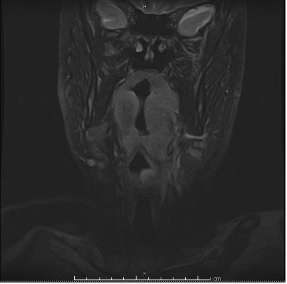 Figure 2: Coronal section MRI.