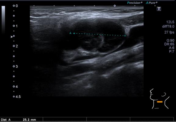 Figure 3: Ultrasound neck-left level 2 lymph node.