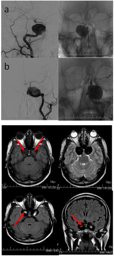 Figure 1: Axial T1 and T2 weighted axial FLAIR axial and coronal MR image revealing the bilateral intracavernous carotid aneurysms (indicated by arrows).