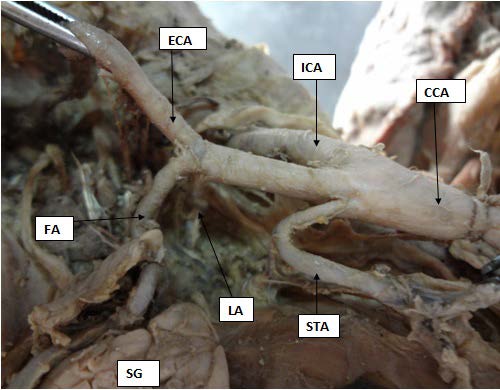 Figure 1: Showing the trifurcation of the common carotid artery into superior thyroid artery (STA), external carotid artery (ECA) and internal carotid artery (ICA).
