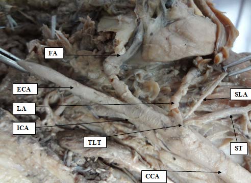 Figure 2: Showing external carotid artery having thyro-lingual trunk (TLT).