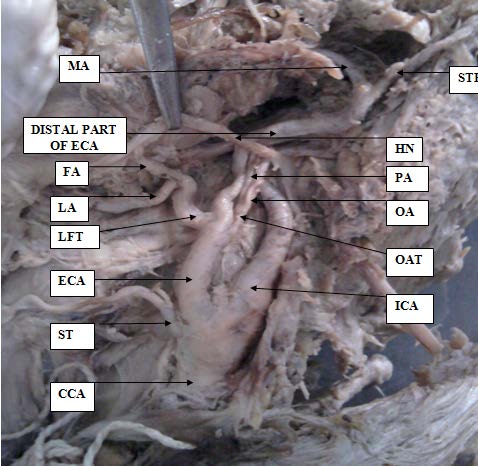 Figure 3: Showing external carotid artery having linguo-facial trunk (LFT) and occipito-auricular Trunk (OAT).