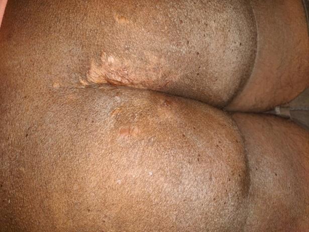 Figure 1: Grade 2 bedsore over sacrum