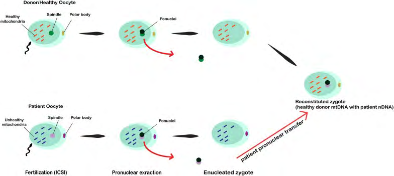 Figure 3: Courtesy ref no-72-In this technique, first, both recipient and donor oocytes are fertilized using the intended partner’s sperm through ICSI. As soon as the pronuclei is formed, the pronuclei from abnormal mtDNA oocyte is transferred into the enucleated abnormal mtDNA zygote using micromanipulation equipment