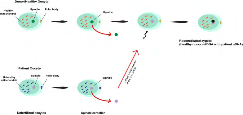 Figure 4: In this technique, the spindle from defective oocytes is extracted and microinjected into donor healthy oocytes in which the spindle is removed. After fertilization by ICSI procedure, the zygote is reconstituted [72].