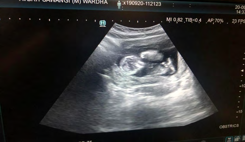 Figure 1: Actual photograph of Ultrasonography showing gestational sac & fetal pole.