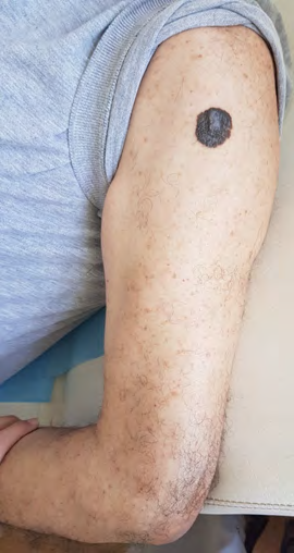 Figure 1: Blackish brown pigmented plaque on the left arm.