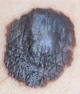 Figure 2: Clinical appearance showing pseudo-follicular openings compatible with the appearance of pigmented seborrheic keratosis.