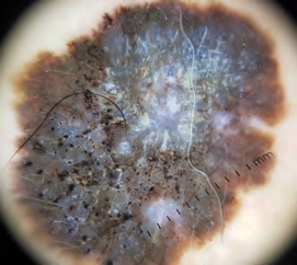 Figure 3: Dermoscopic examination revealed an asymmetrical and pigmented lesion with a bluish, dark brown to light brown and black coloration demonstrating a clearly visible blue-white veil and a rainbow appearance, and multiple pseudo comedones.