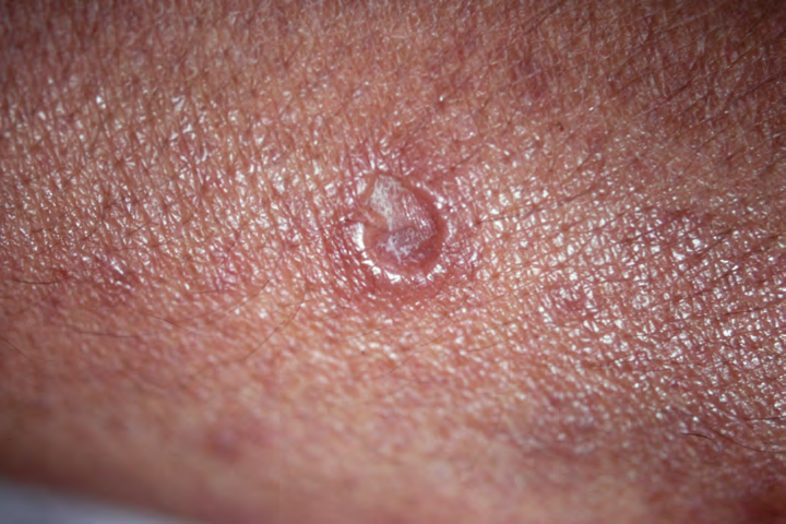 Figure 2: Pathological feature from a nodule on his buttock at our 1st examination; laminated perineurium is seen ( ).
