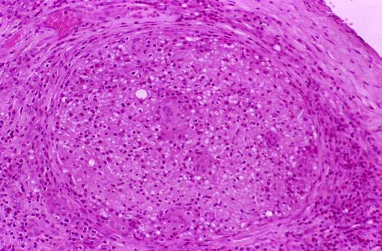 Figure 6: a: Clinical feature on the 1st examination of Patient 2. b, c: Lepromatous granuloma and foamy macrophage containing rod shaped acid-fast bacilli In contrast, drug resistance assays were performed and surprisingly, drug resistance-related-mutations to three drugs, DDS, RFP, and OFLX, were found.