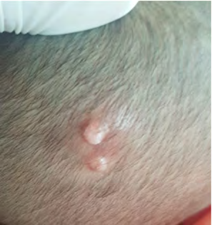 Figure 1: Two well-circumscribed papule and nodule, erythematous in color, 7-10mm in diameter, located on the right scalp vertex.