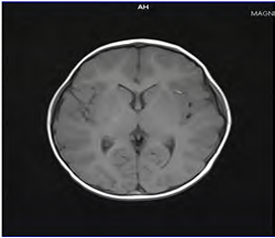 Figure 2: Brain MRI of same patient which reveals normal brain paranchyma.