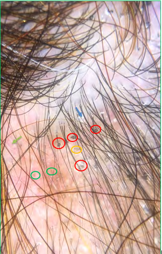 Figure 2: green circles] linear sinuous arborescent vessels [Figure 2: gray arrow]. Corkscrew hairs [Figure 2: red circle] and scales [Figure 2: blue arrow]. Apart from dermoscopic signs of lupus, there have been signs in favor of a tinea capitis, The mycological samples taken were in favor of a trichophyton rubrum, the patient was put on oral and topical griseofulvin as well as hygienic rules adapted with good clinical progress.
