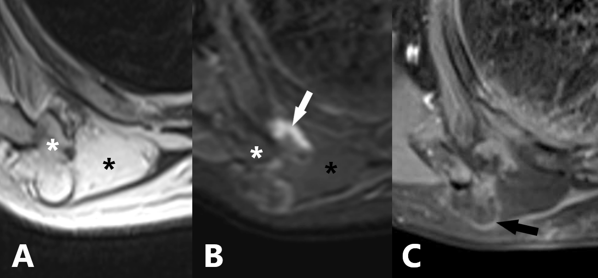 Figure 2: CT of the chest with a bone window A) axial plane, B) coronal plane and C) sagittal plane, Expansive formation with fat attenuation (long white arrow) associated with a bone excrescence in the inferior angle of the right scapula. The bone excretion presents continuity with the bone marrow of the scapula (short white arrows).