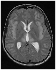 Figure 1: Diffuse cortical hyperintensity with relative sparing of occipital lobes on T2 axial image.