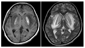 Figure 4: Bilateral symmetrical sub-acute haemorrhage noted in the bilateral basal ganglia with associated surrounding edema on T1 /T2 weighted images. Features are consistent with methanol poisoning.
