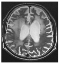 Figure 6: Bilateral symmetrical T2/FLAIR hyperintense signals in the frontal and parietal lobes predominantly involving periventricular region.