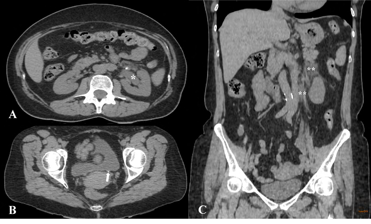 Figure 1: Abdomen CT without contrast, A) Axial plane shows upstream dilatation (white asterisk), B) axial plane shows a 2 mm stone in the distal part of the left ureter (white arrow), C) coronal plane shows the left kidney and upper third of the ureter on the same side had poorly defined limits associated with fat densification (double white asterisk).