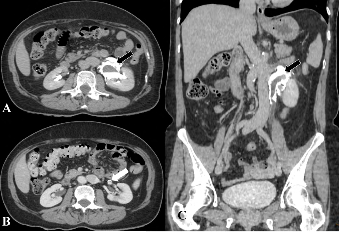 Figure 2: Abdomen CT with intravenous contrast, A) Axial plane, C) Coronal plane: the excretory phases showing the extravasation of the venous contrast medium after venous contrast (black arrow), B) Axial plane: the arterial phases showing small aneurysmatic dilatation at the left renal artery near to renal hilum with no inflammatory signs or evidence of perianeurysmatic fibrosis (white arrow).