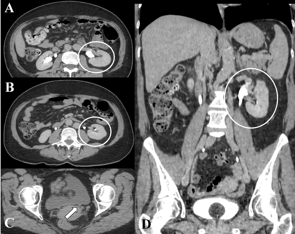 Figure 3: Abdominal CT after two days of hospitalization. A,B) Axial plane and D) Coronal plane: The excretory phases showing no contrast extravasation (white circle). C) Axial plane without contrast: The stone in the distal part of the left ureter was eliminated (white arrow).