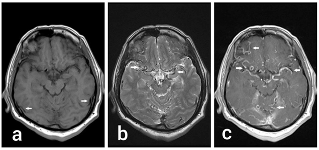 Figure 1: MRI Brain; Axial T1 (a) T2 (b) and Post Contrast T1 (c) images showing multiple enlarged vessels throughout brain in the CSF spaces.