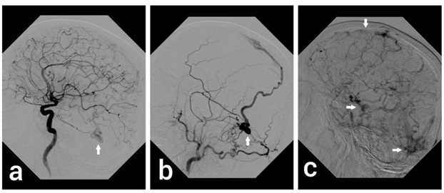 Figure 3: Images from Cerebral DSA. Selective Internal carotid (a) and external carotid (b) arterial phase shows dural AV fistula. Venous phase image (c) shows thrombosis of superior sagittal sinus with numerous dilated collateral venous channels.