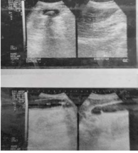 Figure 2: USG which was done 5 year back shows presence of calculus of size 9mm with posterior acoustic shadowing.