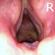 Figure 2: 1-year post operative picture of the larynx with no evidence of disease recurrence.