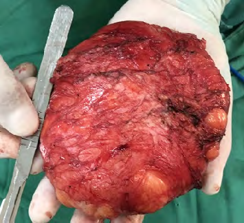 Figure 3: The transoperative findings.