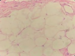 Figure 4: The histopathological tumor.