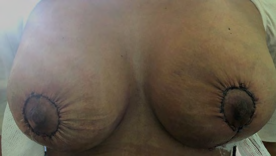 Figure 5: Immediate postoperative.