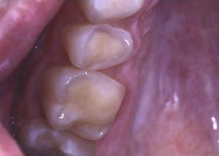 Figure 1: Tooth erosion [1].