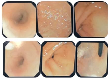 Figure 1: Normal upper digestive endoscopy.
