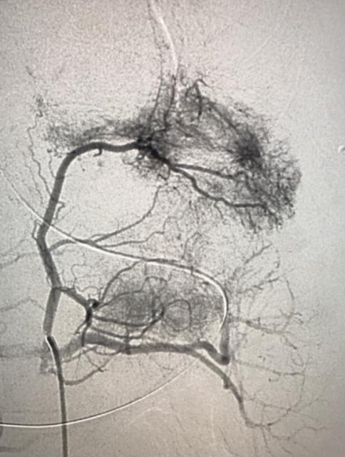 Figure 4: Total gastrectomy and Roux Y esophagojejunostomy.
