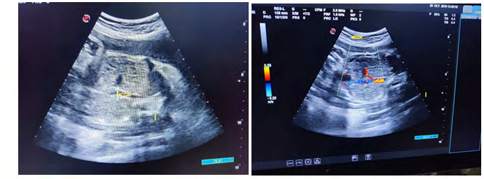 Figure 2: Polycystic Kidneys.