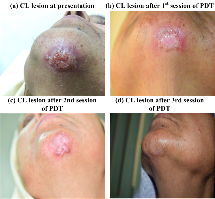 Figure 1: Sample white light photos summarizing the progress of PDT treatment of the CL lesion. Single chronic disfiguring ulcerated lesion on the chin (a), express significant improvement after first (b) and second (c) session of PDT. Complete response with excellent cosmetic results was observed after third session of PDT (d).
