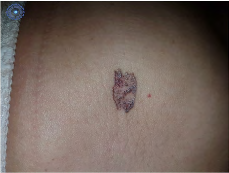 Figure 1: Infiltrated 2 cm plaque with a pearled outline at the level of the right hypochondrium.