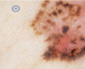 Figure 2: Ovoid nests, dots and globules, eccentric radial striations, and a maple leaf appearance.